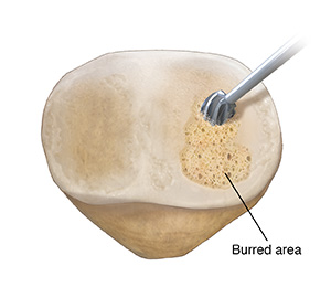 Back view of patella showing instrument burring damaged cartilage. 