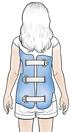 Girl wearing scoliosis brace, viewed from behind.