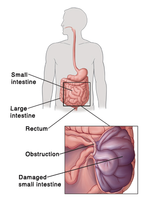 Outline of human figure showing digestive system and pointing out small intestine, large intestine, and rectum. Detail of obstruction trapping part of small intestine. Trapped intestine is damaged.