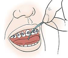 Closeup of mouth showing hand inserting floss between front teeth with floss threader.