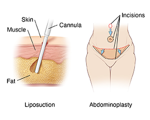 Two images: left one shows skin layers with cannula removing fat during liposuction; right one shows female abdomen with incisions for abdominoplasty.