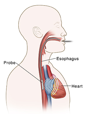 Side view of male head and chest showing probe in esophagus for transesophageal echo.