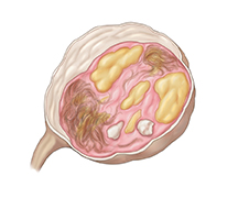 Cross section of ovary showing dermoid cyst.
