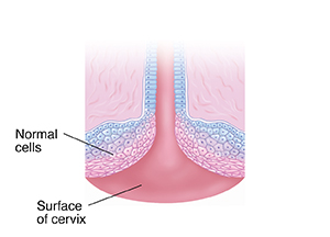 Cross section of cervix showing normal cells.