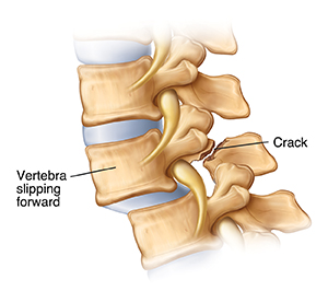 Side view of lumbar vertebrae with spondololysthesis showing fracture at back of one vertebra.