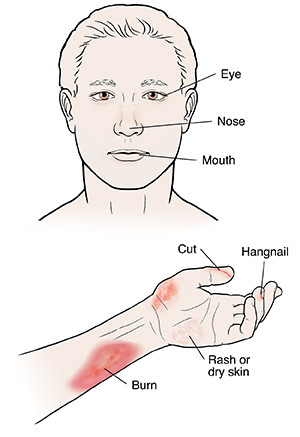 Man's head and arm showing burn, rash, cut injuries to skin.