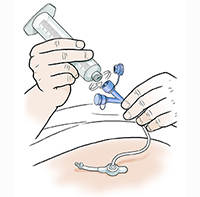 Hands connecting twist-on syringe to port on feeding tube.