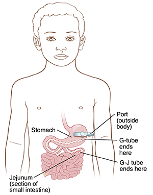 Front view of boy showing stomach and small intestine. Port is outside body over stomach. Tube is connected to port and goes through skin. G-tube ends in stomach. G-J tube ends in jejunum (section of small intestine).