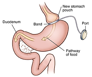 Front view of stomach showing adjustable gastric banding. Arrows show path of food.