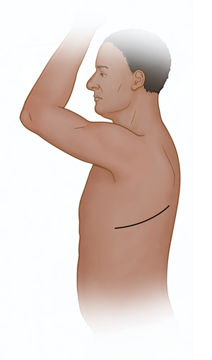 Side view of male torso showing possible incision site for thoracotomy.