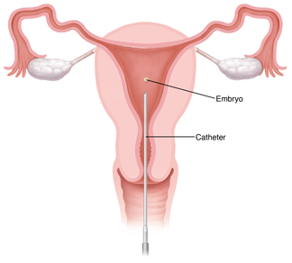 Front view cross section of female reproductive tract showing catheter releasing embryo into uterus for in vitro fertilization.