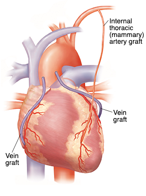 Front view of heart showing three bypass grafts on coronary arteries.