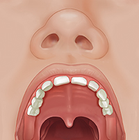 Front view of child's open mouth showing normal palate.