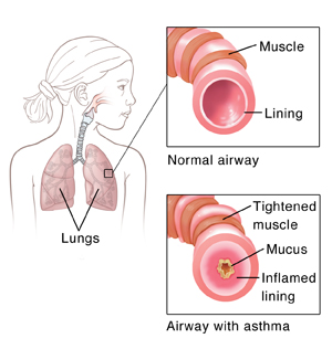 Outline of child showing respiratory system. Insets show normal airway and airway with asthma.