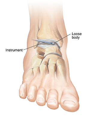 Closeup of instrument removing loose body from ankle joint.