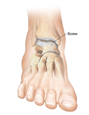 Front view of foot showing screw holding cartilage in place on ankle bone.