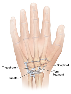Back view of hand showing torn ligament in wrist.