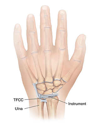 Back view of hand showing instrument repairing damaged cartilage in wrist.