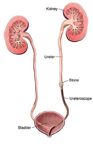 Front view of kidney, ureter, and bladder showing ureteroscope in ureter with laser breaking up kidney stone.