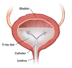 Cross section of bladder showing catheter inserted through ureter, releasing x-ray dye.