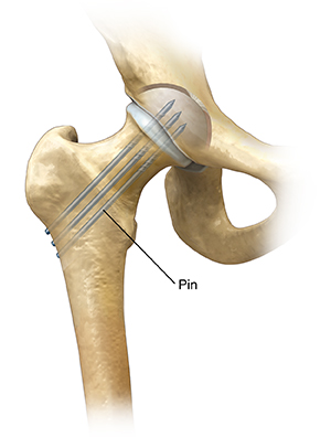Front view of hip joint showing pins repairing femoral fracture.