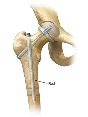 Front view of hip joint showing rod repairing femoral fracture. 