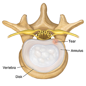 Top view of lumbar vertebra and disk showing tear in annulus.