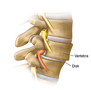Side view of lumbar spine showing one vertebra slipping forward and pressing on nerve.