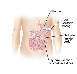 Front view of child's abdomen showing G-J tube inserted through body wall into stomach with tube going into small intestine..