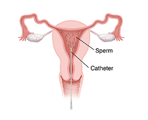 Front view cross section of uterus showing catheter inserting sperm into uterus during intrauterine insemination.