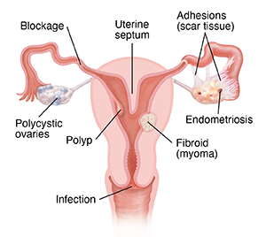 Cross section front view of female reproductive system showing polycystic ovary, blockage in fallopian tube, fibroid in wall of uterus, endometriosis, adhesions, septum in uterus, polyp in uterus, and Infection in cervix.
