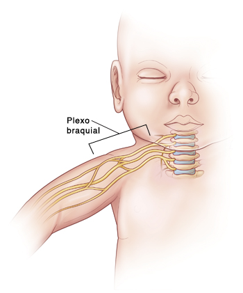 Contorno de un bebé que muestra los nervios que salen de la columna vertebral en el cuello y que bajan hacia el brazo. El plexo braquial es un grupo de nervios en el cuello y en el hombro.