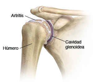 Vista frontal de la articulación del hombro con artritis.