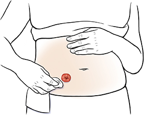 Primer plano de un abdomen donde pueden verse manos que limpian alrededor del estoma.
