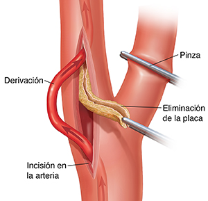 Arteria carótida que muestra una incisión con un instrumento que quita la placa y una derivación que desvía el flujo sanguíneo.