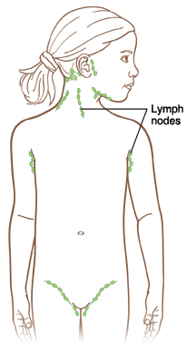 Contorno de un niño que muestra los ganglios linfáticos delante y detrás de la oreja, en los laterales y parte trasera del cuello, debajo del mentón, en las axilas y en la entrepierna.