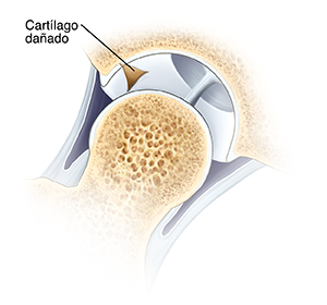 Corte transversal de una articulación de cadera en donde se ve la cabeza del fémur que se separó de la cavidad de la cadera. Parte del cartílago que reviste la cavidad está dañado.