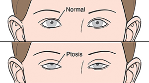 Ojos abiertos normales comparados con ojos con ptosis. Los ojos con ptosis parecen estar parcialmente cerrados.