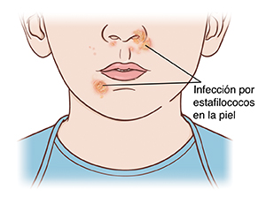 Primer plano de la parte inferior de cara y cuello. Llagas de infección por estafilococos en la nariz y cerca de la boca.