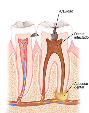 Corte transversal de dos dientes donde se observan caries, infección y un absceso dental.