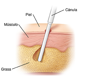 Capas de piel que muestran la cánula extirpando grasa durante la liposucción.