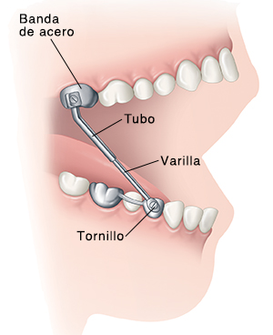 Vista lateral de los dientes en la boca abierta que muestra el aparato de Herbst colocado en los dientes superiores e inferiores.