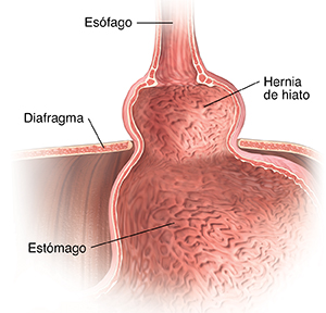 Primer plano de corte transversal de la parte superior del estómago, la parte inferior del esófago y el diafragma donde puede verse una hernia de hiato.