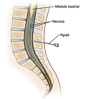 Corte transversal de la parte lumbar de la espalda, donde se muestra la aguja insertada en el espacio epidural.