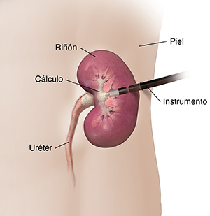 Vista frontal del costado izquierdo donde se muestra el riñón con un cálculo. Se introduce un instrumento a través de la piel hasta el riñón para romper el cálculo.