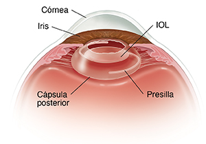 Corte transversal del frente de un ojo en donde se ve la LIO en la cápsula posterior.
