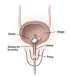 Vista frontal del pene que muestra un corte transversal de la vejiga y de la uretra. Se inserta un catéter a través de la uretra hacia adentro de la vejiga.