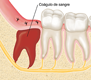 Primer plano de corte transversal de maxilar y molares en donde se ve un coágulo de sangre en el lugar donde se extrajo una muela de juicio.
