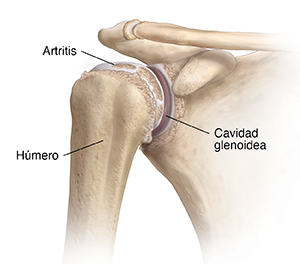 Vista frontal de la articulación del hombro con artritis.