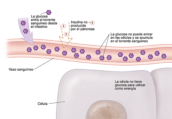 Primer plano de un corte transversal de un vaso sanguíneo cerca de células donde se muestra la diabetes tipo 1. No se produce insulina. La glucosa no puede entrar en las células y se acumula en el torrente sanguíneo. La célula no tiene glucosa para utilizar como energía.